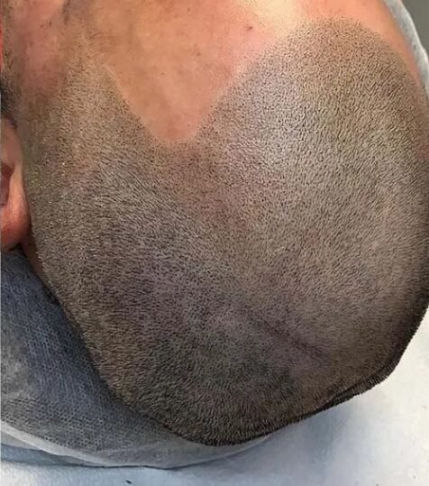 Nach Behandlung Haarpigmentierung (SMP) Mönchengladbach